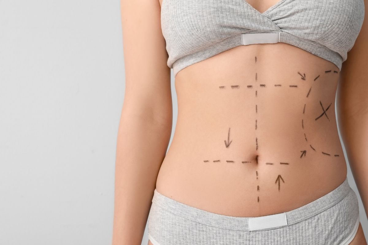 Op. Dr. Kadri Akıncı 360 Body Lift
