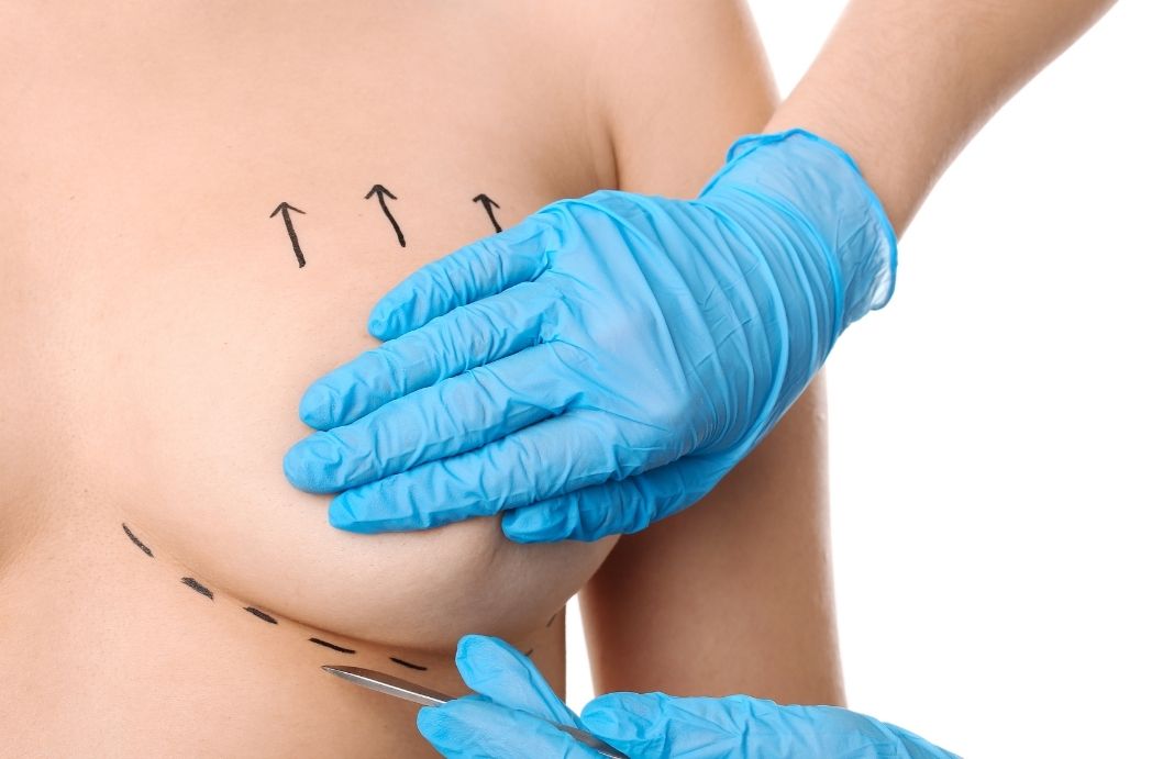 Breast Augmentation With Implants