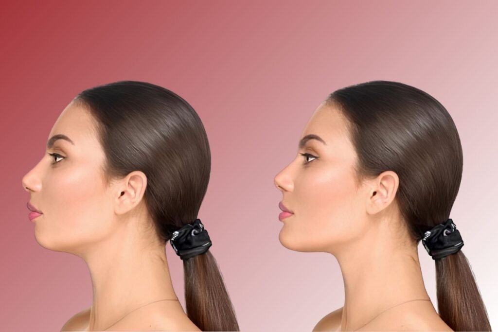 Chin Implant in Istanbul